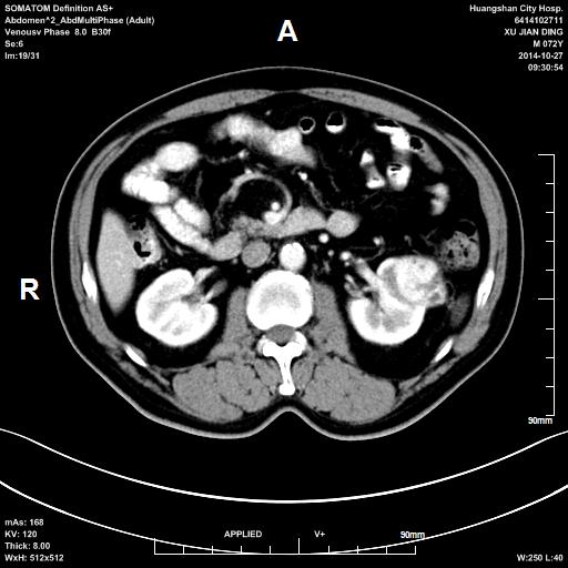 CT1