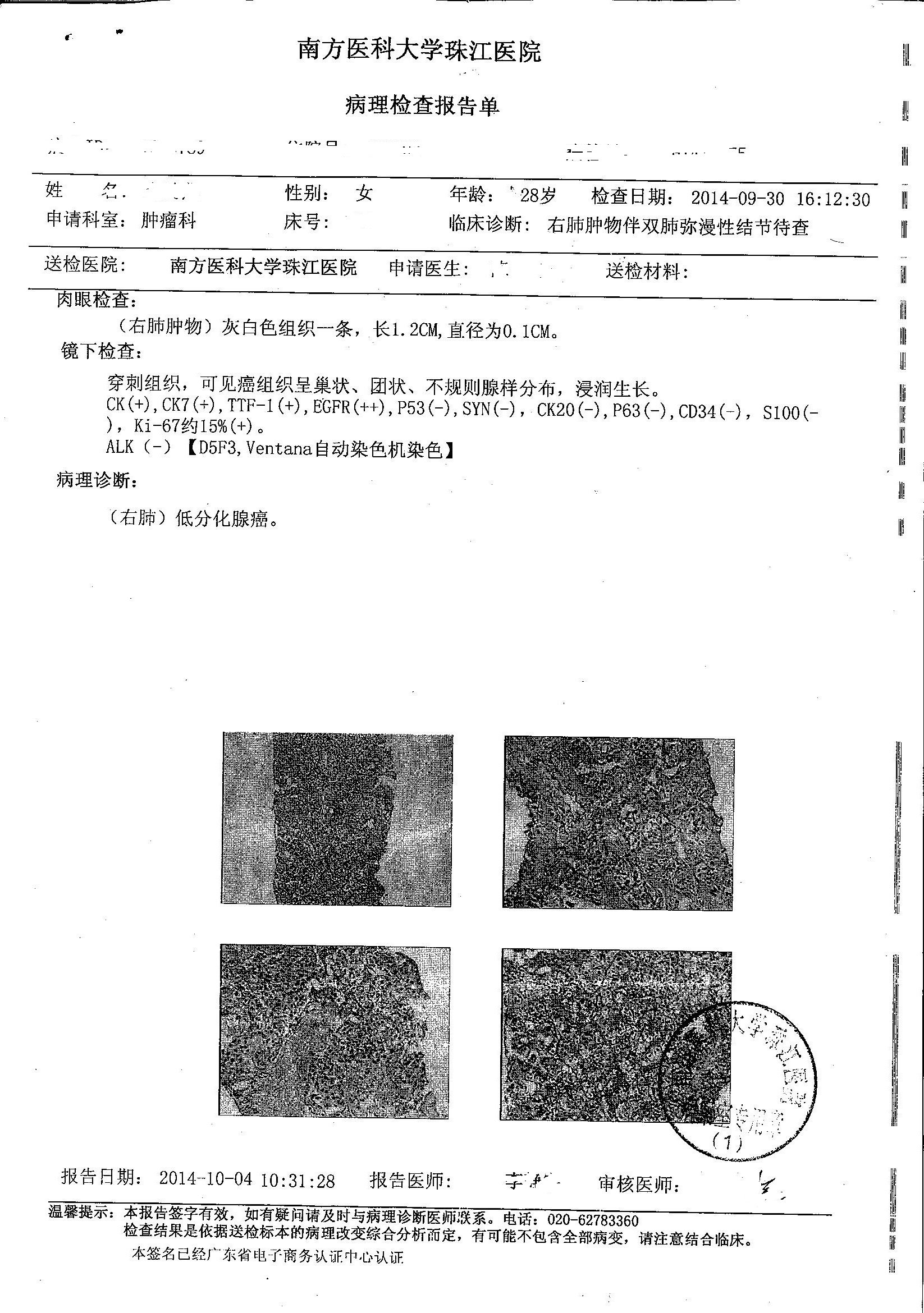 珠江病理报告.jpg