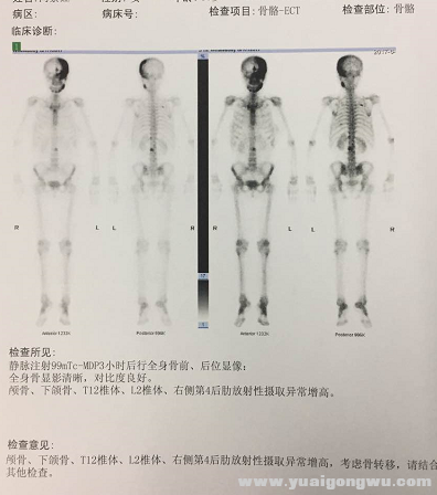 骨头多出转移