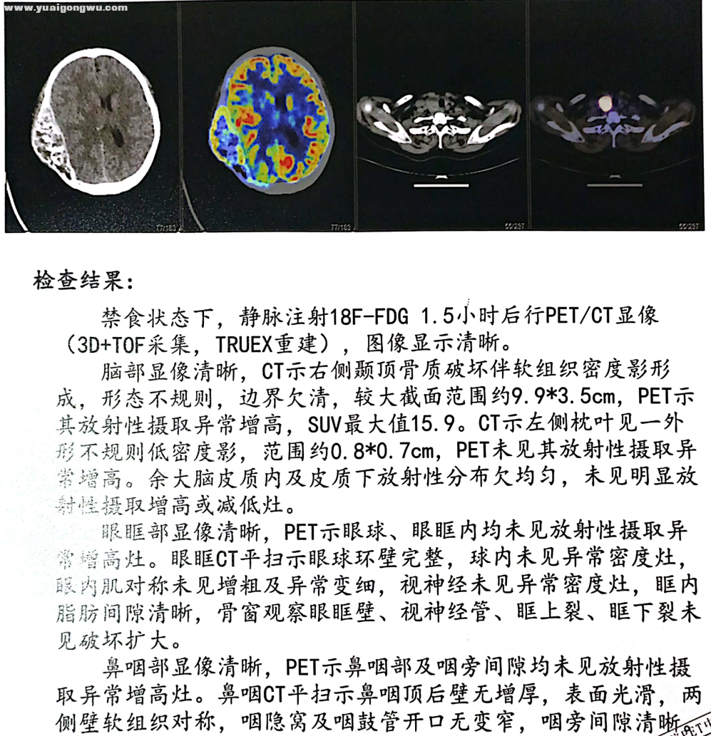 脑部pet-ct